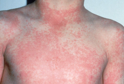 Seafood Allergy
